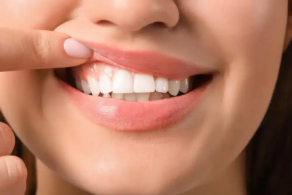 Gum Contouring