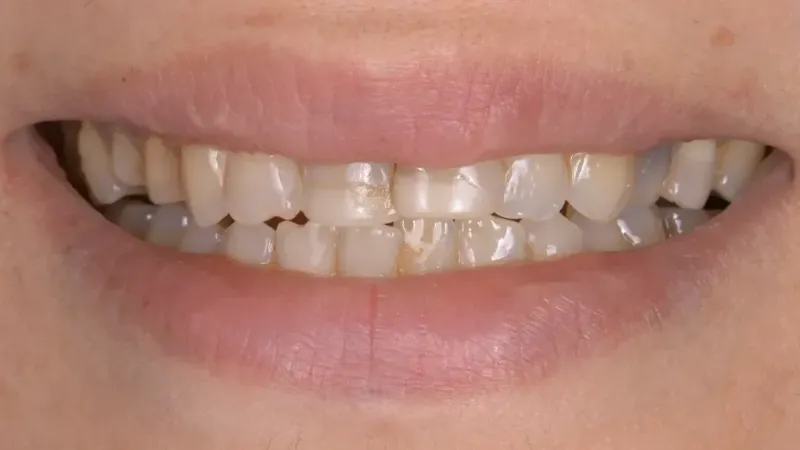 crowns bridges before 2