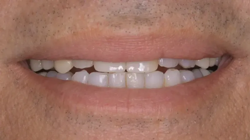 smile makeover before 6